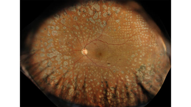 Image showing diabetic retinopathy from GAIA