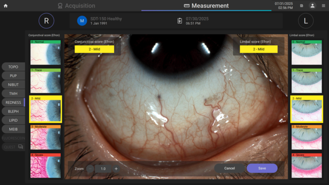 Ocular Redness Assessment