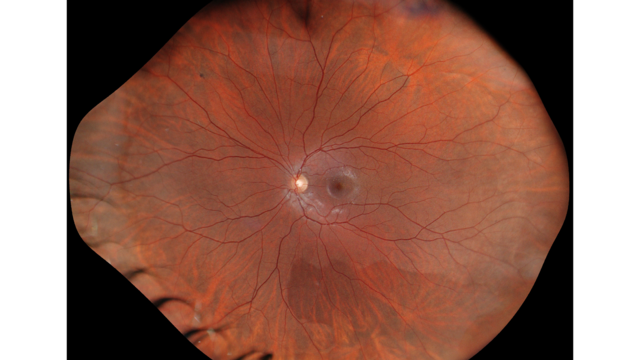 Ultra-widefield fundus image from GAIA