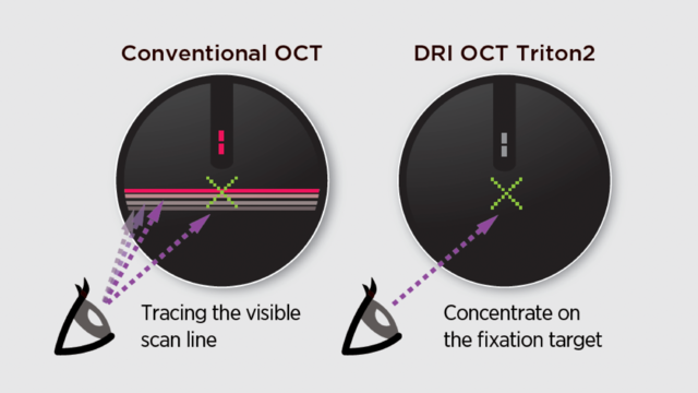 Conventional OCT vs Triton2