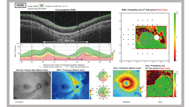 Hood Report for Glaucoma