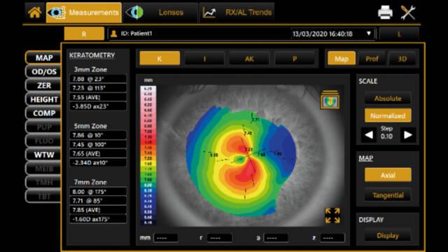corneal topography