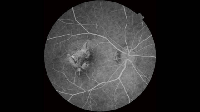 Fluorescein Angiography image