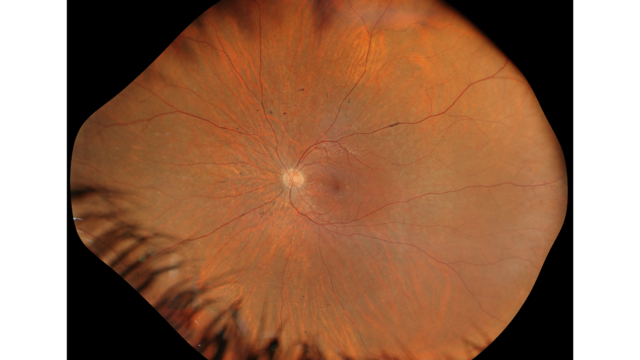 True colour fundus image from GAIA